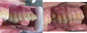 Lingual v094sr - Eugenol