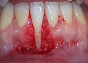 Lit receveur njupvg - Eugenol