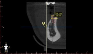 Llargeur cr te0 coronal view jvd7qq - Eugenol