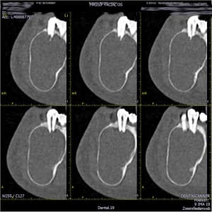 Mandibule  019 so1jrl - Eugenol