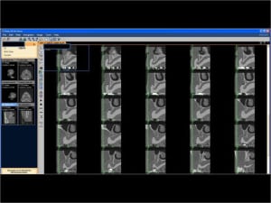 Mise en charge imm diate   expansion osseuse 005 hb5neo - Eugenol