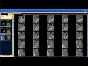 Mise en charge imm diate   expansion osseuse 007 mfozme - Eugenol