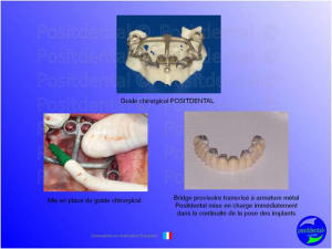 Mise en charge imm diate   expansion osseuse 011 v1osru - Eugenol