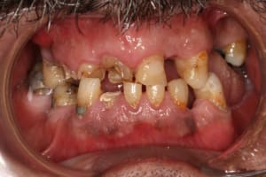 Occlusion pr  op cgna2r - Eugenol