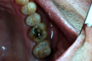 Occlusion yglh04 - Eugenol