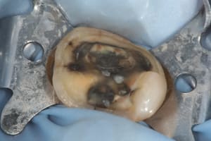 Onlay079 yt1tbf - Eugenol