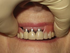 Overdenture dbbpb6 - Eugenol