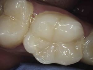 Pas de couronne chiotte   aibhmx - Eugenol