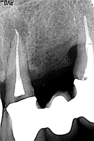 Post op d21 le 17 01 05 km0apu - Eugenol