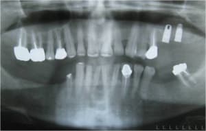 Post op pnpnov - Eugenol