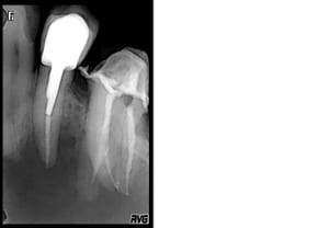 Post op yoe5nw - Eugenol