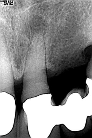 Pré op d21 le 17 01 05 j09oxc - Eugenol