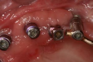 Pr  op  proth ses sur implants  haunt bas 005 o8z5us - Eugenol