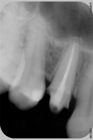 Radio 14 taille cerec tfrxuv - Eugenol
