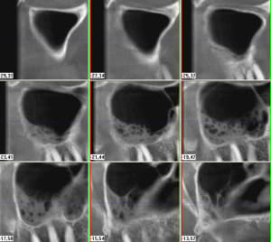 Sinus droit ymrbjj - Eugenol