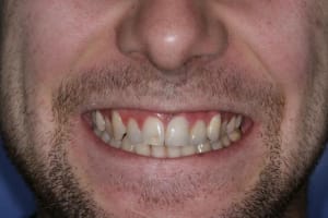 Sourire forc  fjo256 - Eugenol
