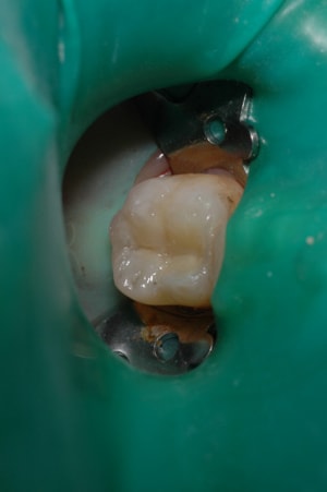 Strat dentine2 mlafea - Eugenol