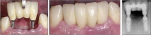 Surgical 4s zkt8un - Eugenol