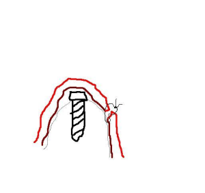 Suture ekvdky - Eugenol