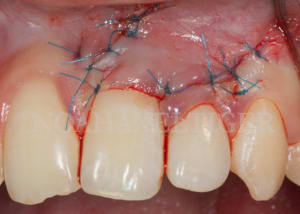 Sutures e7ixmz - Eugenol