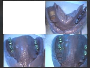 Un cas difficile empreintes définitives rpsmnk - Eugenol