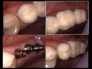 Un cas difficile essai bridge sur implants 25 et 26 et 27 evznvr - Eugenol