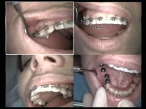 Un cas difficile ortho en cours après réouverture 2 rcsagb - Eugenol