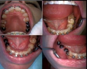 Un cas difficile ortho en cours après réouverture 4 kelt6e - Eugenol