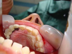Vue palatine x8r5s3 - Eugenol