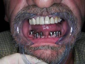 Z et les primaires en bouche - Eugenol