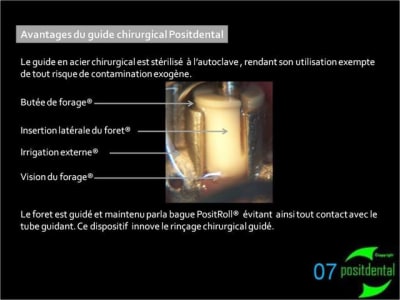 07 positdental guide chirurgical juxta muqueux   appuis dentaires mw5fpu - Eugenol