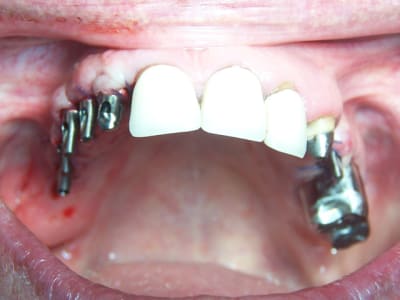 09 07 01positdental  047 mh58k3 - Eugenol