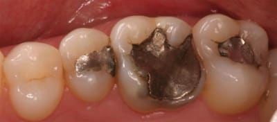 1 q1 amalgames  medium  tzwpet - Eugenol