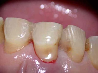 11 resplintée r0gado - Eugenol