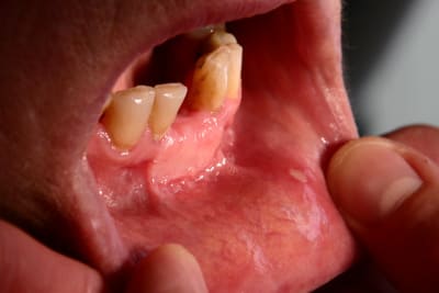 13 greffe a 8 semaines gwucow - Eugenol