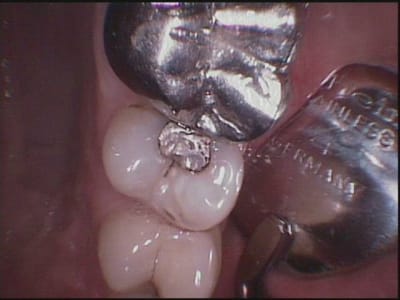 15 avant traitement crtoip - Eugenol