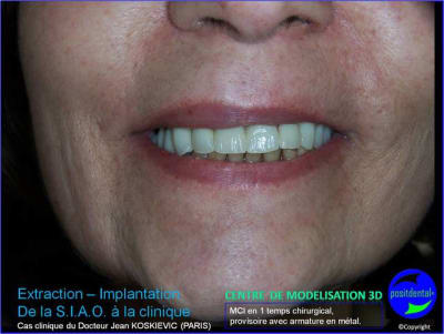 17 extraction mci bridge provisoire avec armature m tal p8xmry - Eugenol