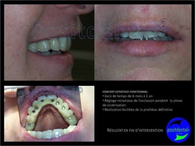1 planification implantaire   mise en charge imm diate post extractionnelle   mcipe 014 tedg9w - Eugenol