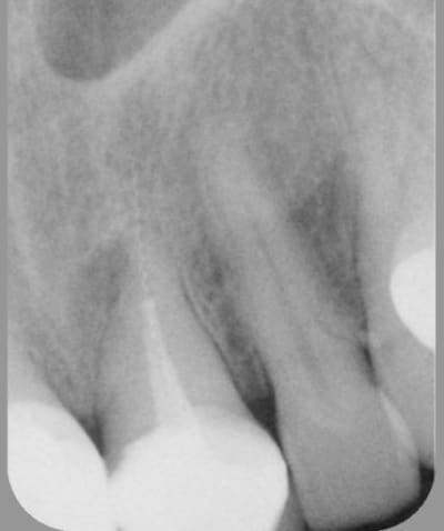 21 preop ipjgeu - Eugenol