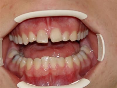 21 reconstituée en cerec en urgence mqzgwq - Eugenol