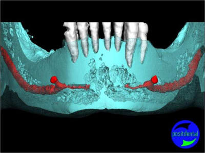 3 positdental mod lisation 3d phpw6w - Eugenol