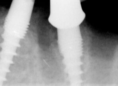 36 r  post op e5ohkz - Eugenol