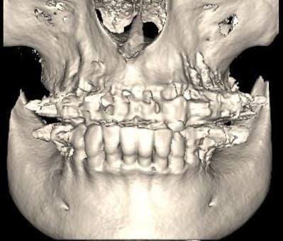 3d icat tvee4c - Eugenol