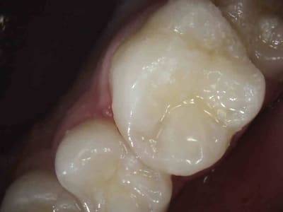 3 pcpllp - Eugenol