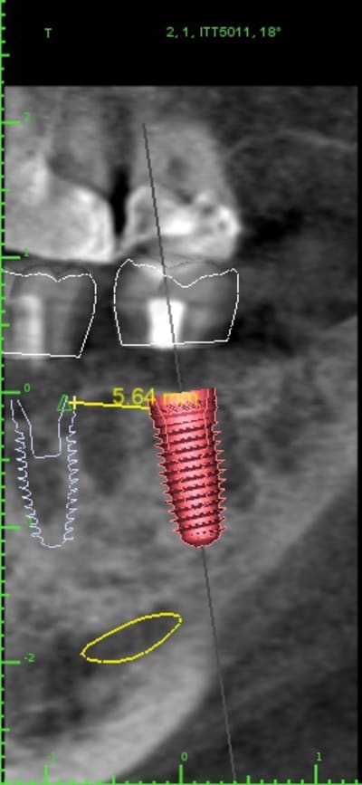 3implants2 implant view dj28sl - Eugenol