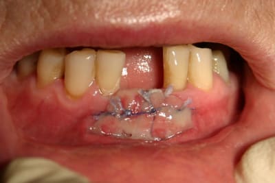4 greffe à 7j gef51z - Eugenol