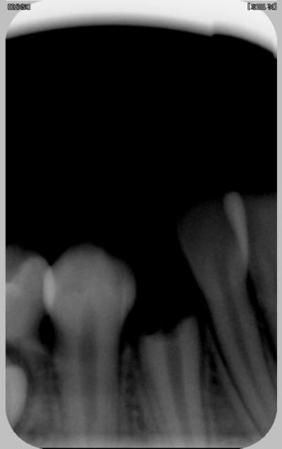 43 sans couronne ihlz2a - Eugenol