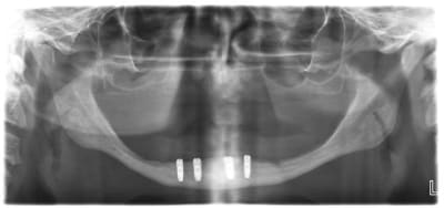 4st i acylea - Eugenol