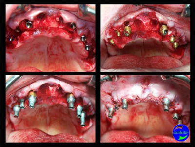 5 extraction mci bridge provisoire avec armature m tal ibocgc - Eugenol
