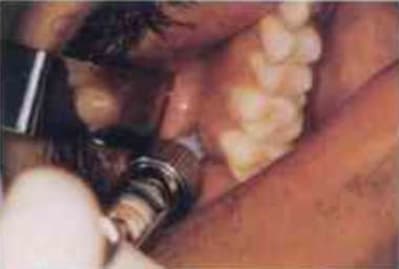 Analg sie tub rositaire haute   en clinique vflfea - Eugenol